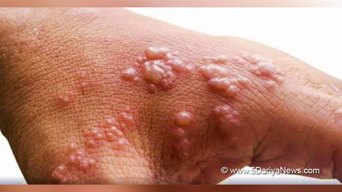 Health, Monkeypox Virus, Monkeypox, Health, Study, Research, Researches, Symptoms Monkeypox Virus, MonkeyPox Disease, Monkeypox Symptoms, MonkeyPox Cures, World Health Organization, WHO